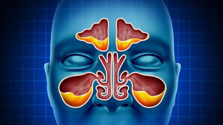 A 3D illustration of congested sinuses.