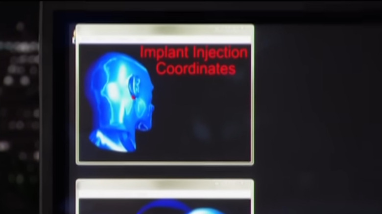 Concept images from Shark Tank of the Ionic Ear being implanted surgically