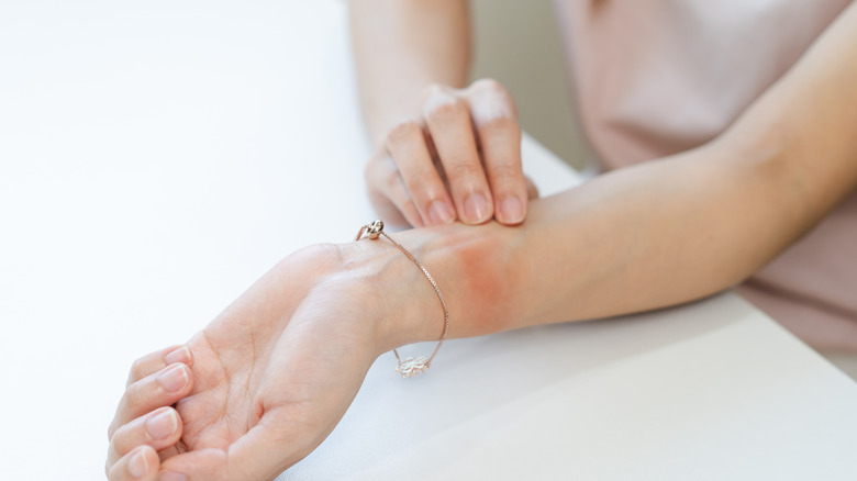 Cose-Up of woman's wrist showing red marks of skin irritation