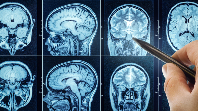 hand with pen pointing at brain scan MRI