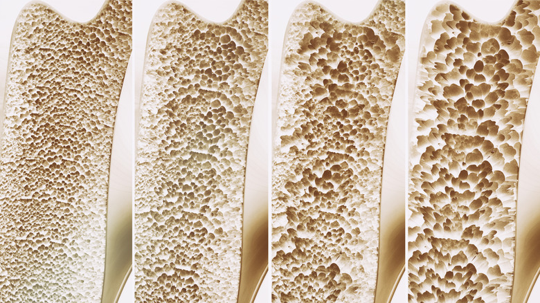 Stages of osteoporosis and their impact on bone structure.