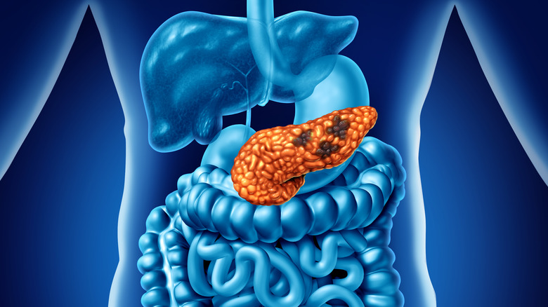 Rendered concept of pancreatic cancer in the human body.