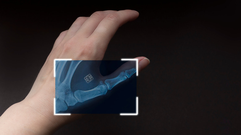 X-ray of hand with a small chip visible just beside the thumb.